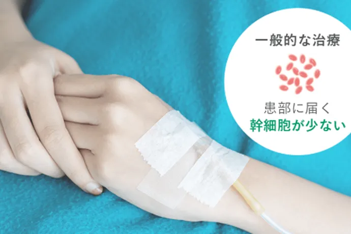 一般的な脊髄損傷の再生医療のイメージ画像 一般的な治療だと、幹部に届く幹細胞が少ない