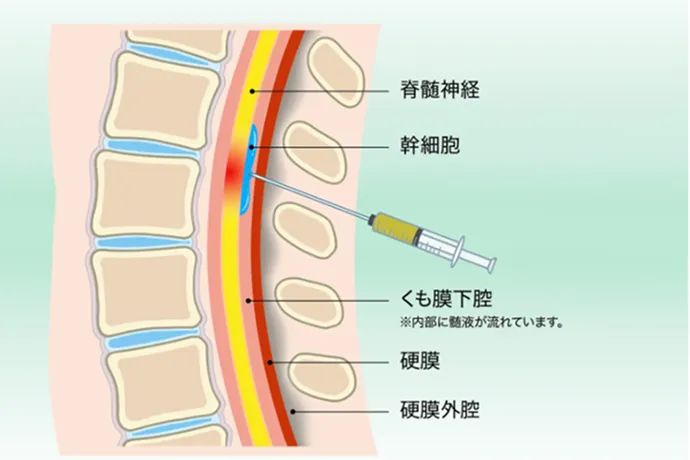 脊髄腔内ダイレクト注射療法の解説イラスト