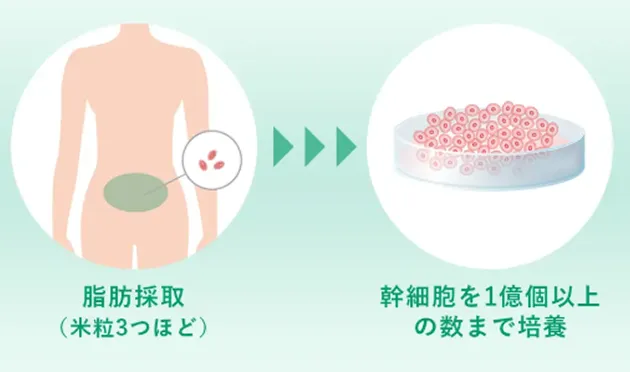脂肪採取(米粒3つほど) 幹細胞を1億個以上の数まで培養