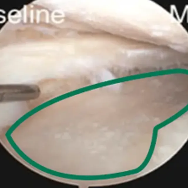 一般的な培養の幹細胞投与6か月目