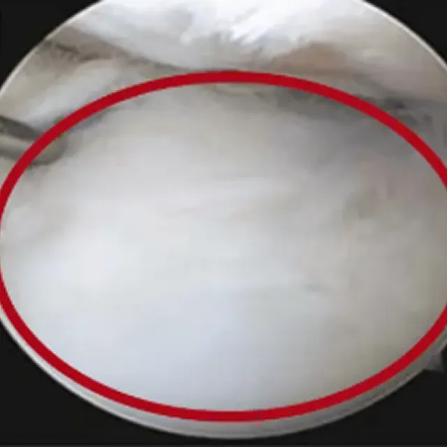 当院の治療の幹細胞投与6か月目