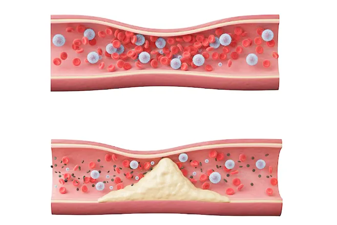 動脈硬化の解説イラスト