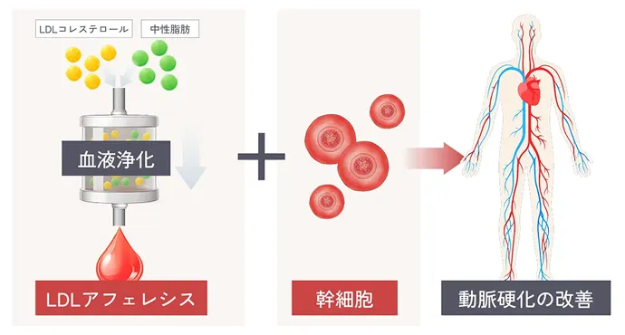再生医療×LDLアフェレシス 併用のシナジーの解説イラスト