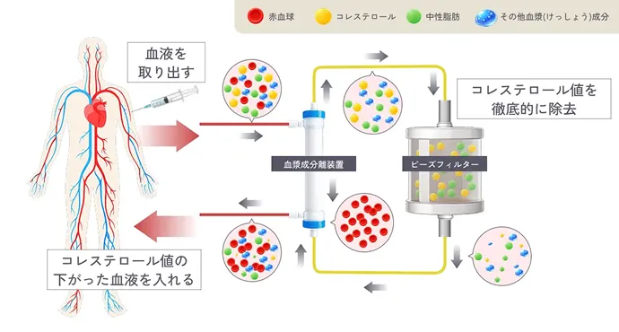 再生医療×LDLアフェレシス 併用のシナジーの解説イラスト