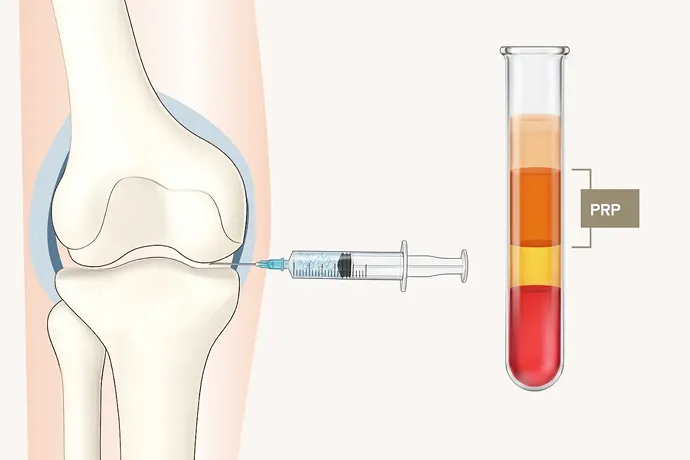 PRP療法の解説イラスト
