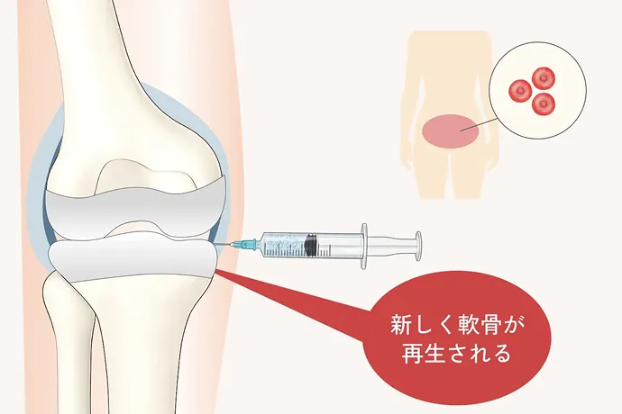 幹細胞治療の解説イラスト