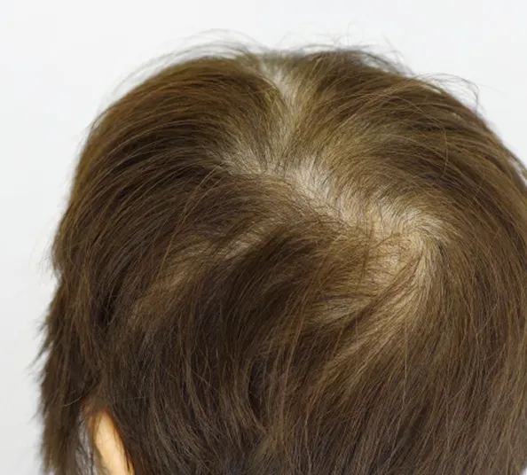 幹細胞で毛髪再生のイメージ画像