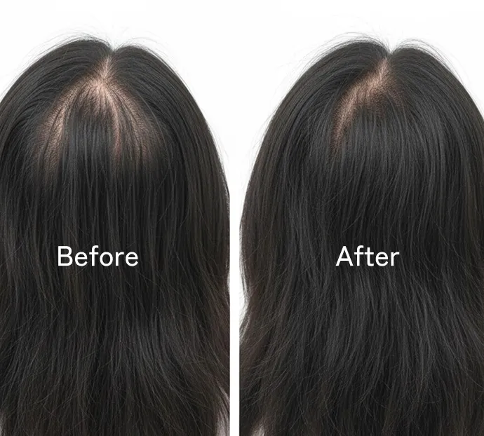 PRP毛髪治療のビフォーアフター写真