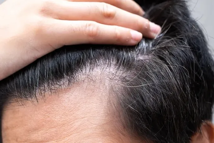 男性型脱毛症のイメージ画像