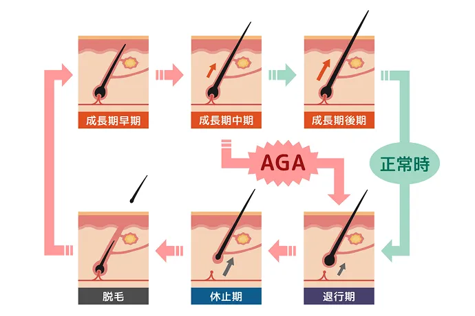 AGAのメカニズムの解説イラスト