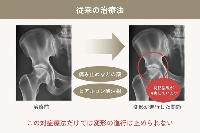 従来の治療法のイメージ図 この対症療法だけでは変形の進行は止められない