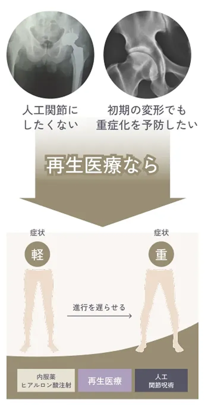 人口関節にしたくない 初期の変形でも重症化を予防したい 再生医療なら 進行を遅らせる治療のイメージ図