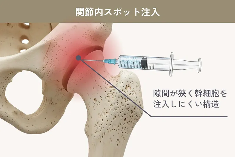 関節内スポット注射の解説イラスト