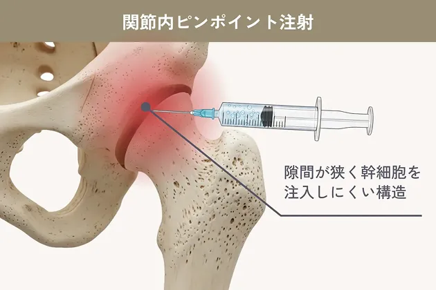 関節内ピンポイント注射の解説イラスト