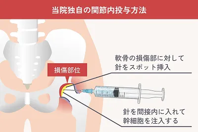 当院独自の関節内投与方法の解説イラスト