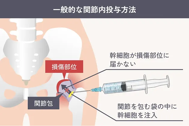 一般的な関節内投与方法の解説イラスト