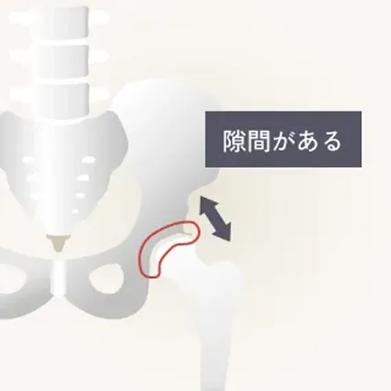 変形性股関節症初期の解説イラスト