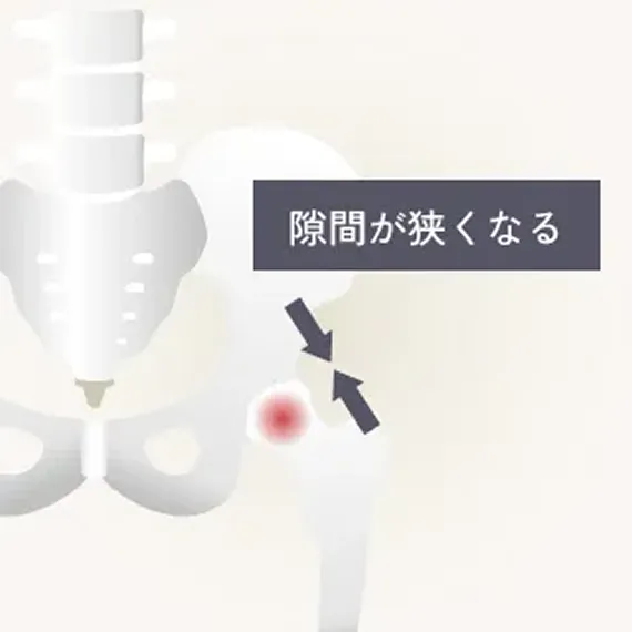 変形性股関節症進行期の解説イラスト