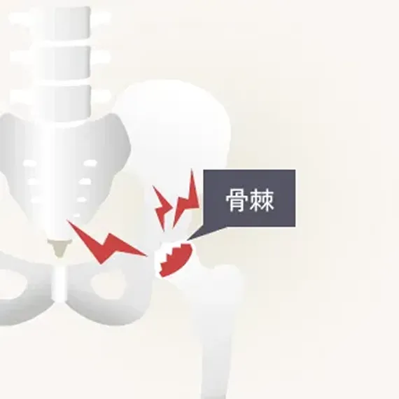 変形性股関節症末期の解説イラスト