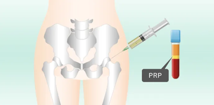 PRP療法の解説イラスト