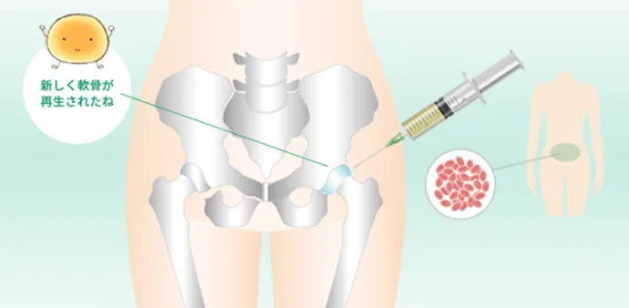幹細胞治療の解説イラスト