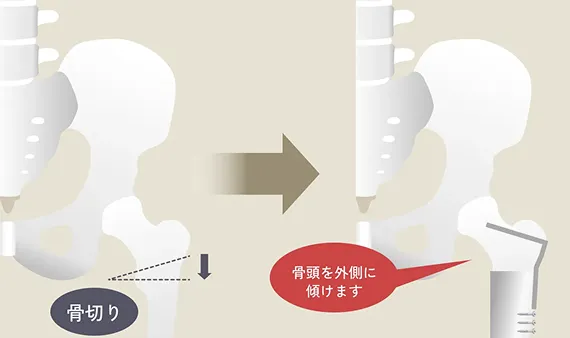 外反骨切り術のイラスト解説