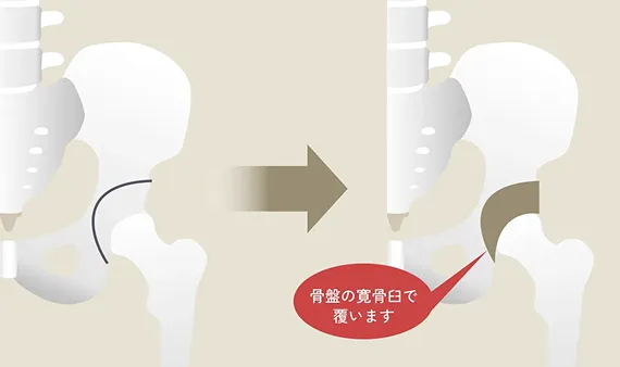 寛骨臼回転骨切り術のイラスト解説