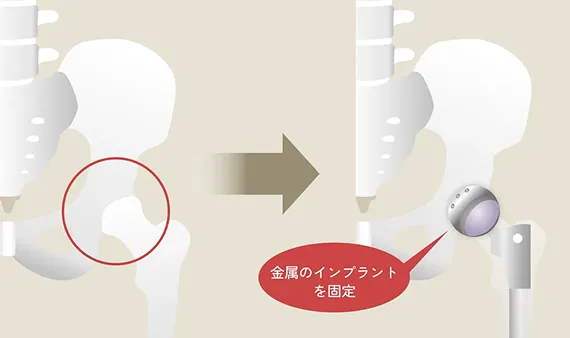 人工股関節置換術のイラスト解説