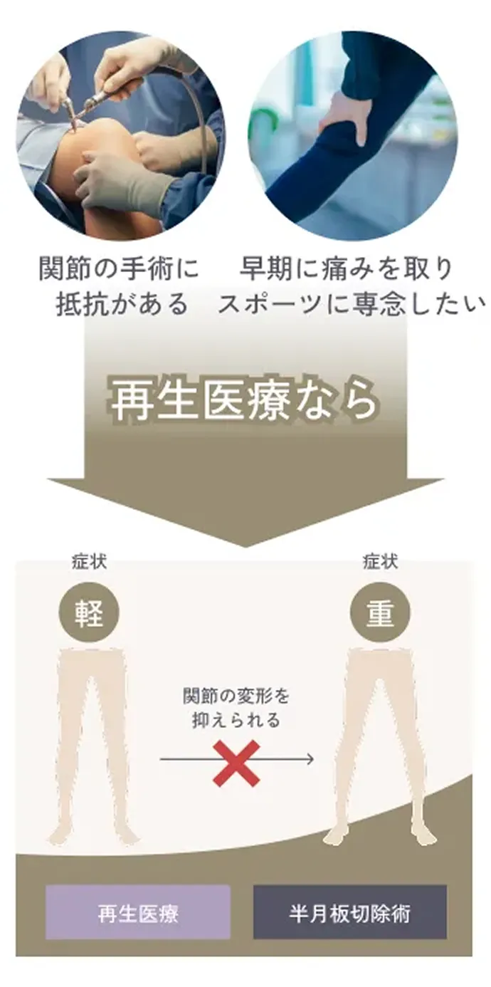 人口関節にしたくない 重症化するのを予防したい 再生医療なら 再生医療のイラスト解説