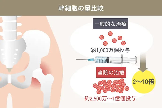幹細胞の量比較 一般的な治療の解説イラスト