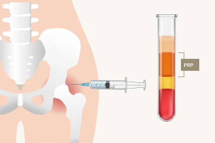 PRP療法で血小板を多く含むPRPを取り出し、股関節に注入するイラスト解説