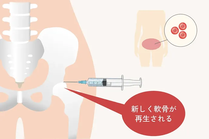 幹細胞治療で身体から幹細胞を取り出し、股関節に注入するイラスト解説
