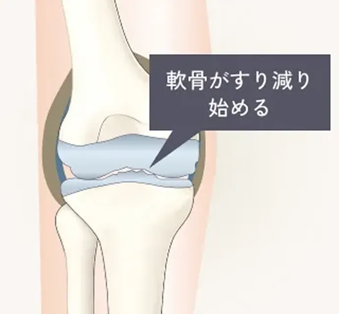 変形性ひざ関節症初期の解説イラスト