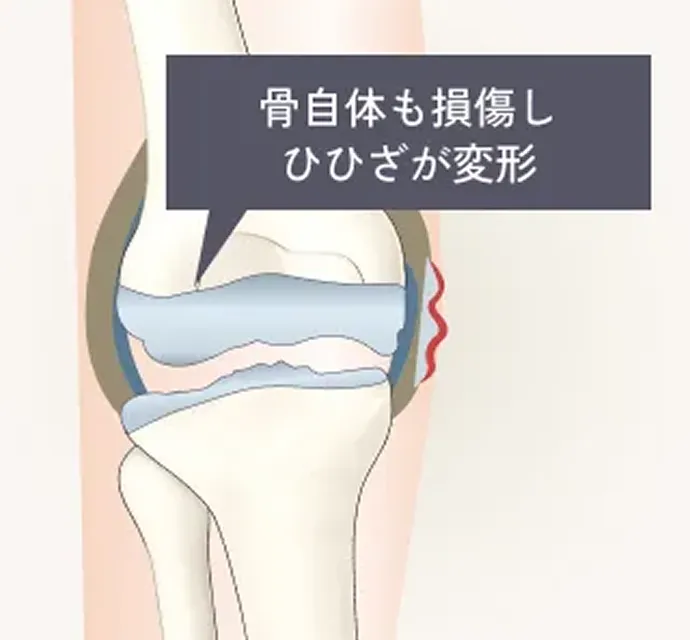 変形性ひざ関節症末期のイラスト解説