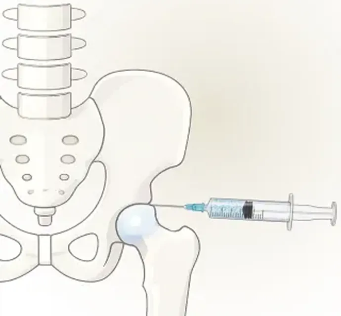ステップ3 患部へ注射