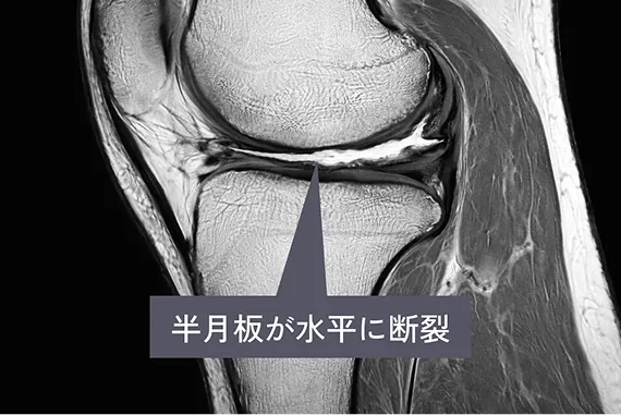半月板が水平に断裂している様子を示したMRI写真