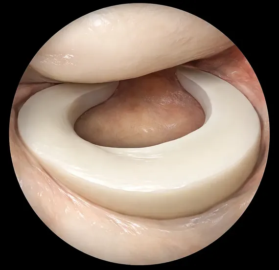 関節鏡所見での正常時