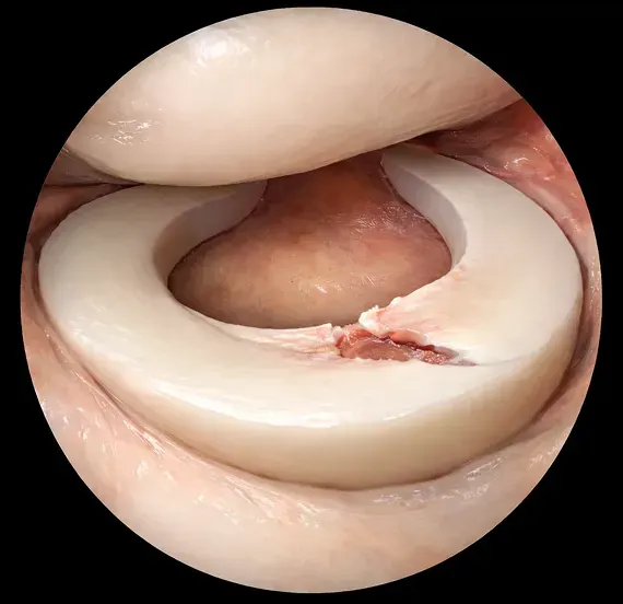 関節鏡所見での半月板損傷時
