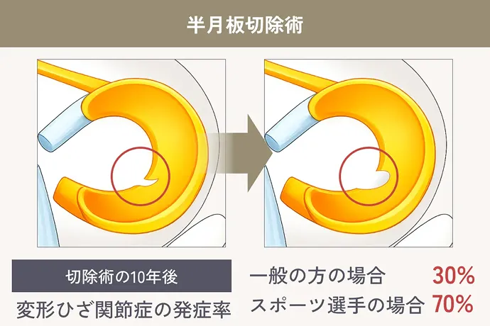 半月板切除術 切除後の10年後 変形ひざ関節症の発症率 一般の方の場合 30% スポーツ選手の場合 70%