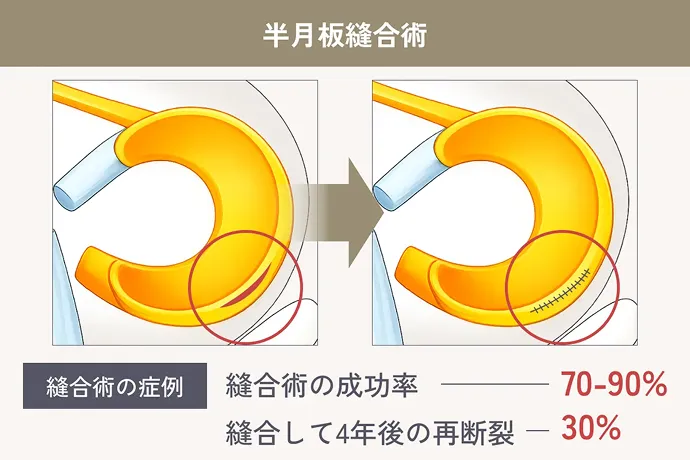 半月板縫合術 縫合術の場合 縫合術の成功率 70-90% 縫合して4年後の再断裂 30%