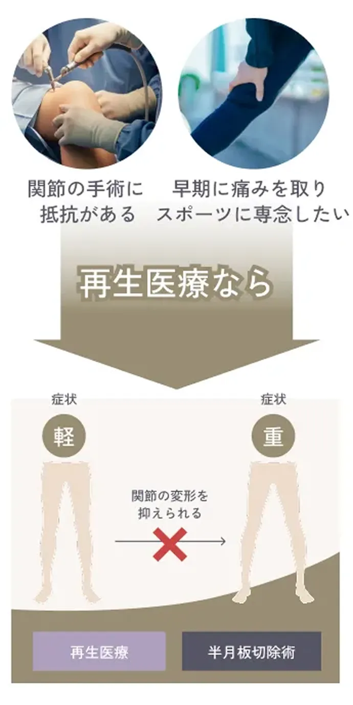 関節の手術に抵抗がある 早期に痛みを取りスポーツに専念したい 再生医療なら 再生医療 半月板切除術 関節の変形を抑えられる