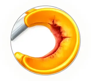 半月板損傷の拡大のイラスト解説