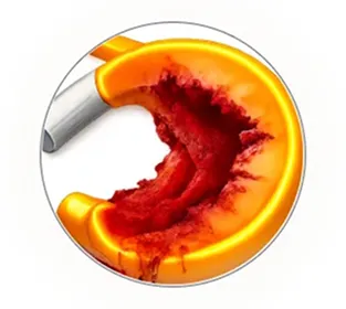 半月板損傷の拡大のイラスト解説