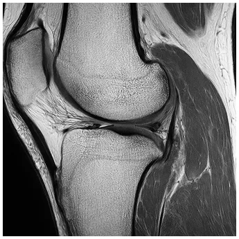 半月板の正常時の写真