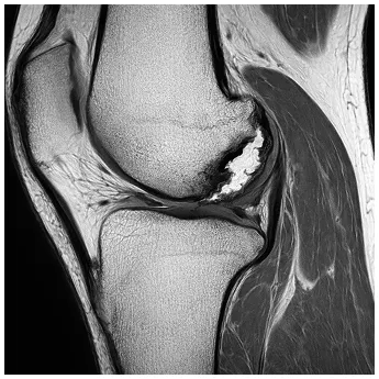 半月板損傷時の写真