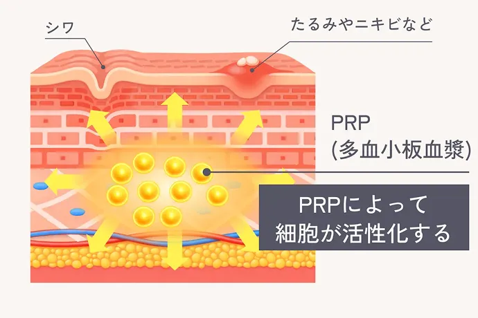 高濃度PRPによる肌再生の図解