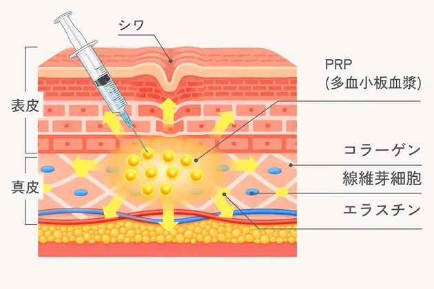 高濃度PRPの注入の図解
