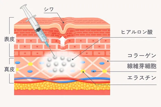ヒアルロン酸の注入の図解