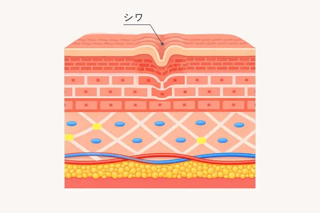 再びシワが出現したお肌の図解