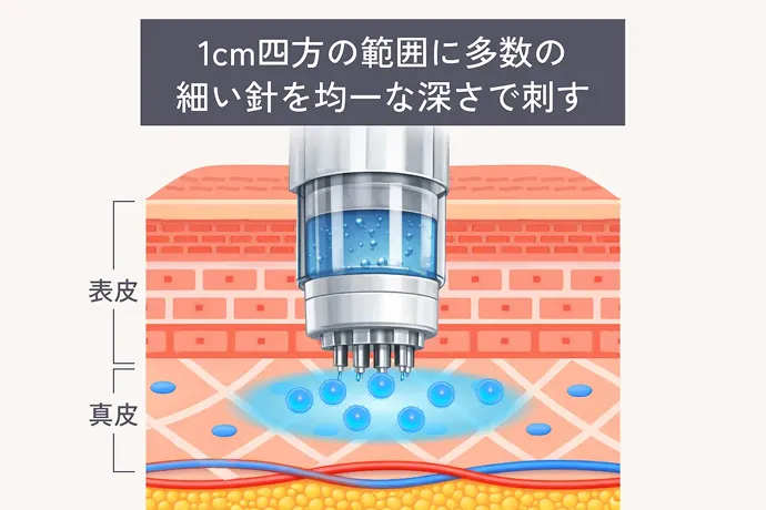 水光注射のイメージ図解 1cm四方の範囲に多数の細い針を均一な深さで刺す